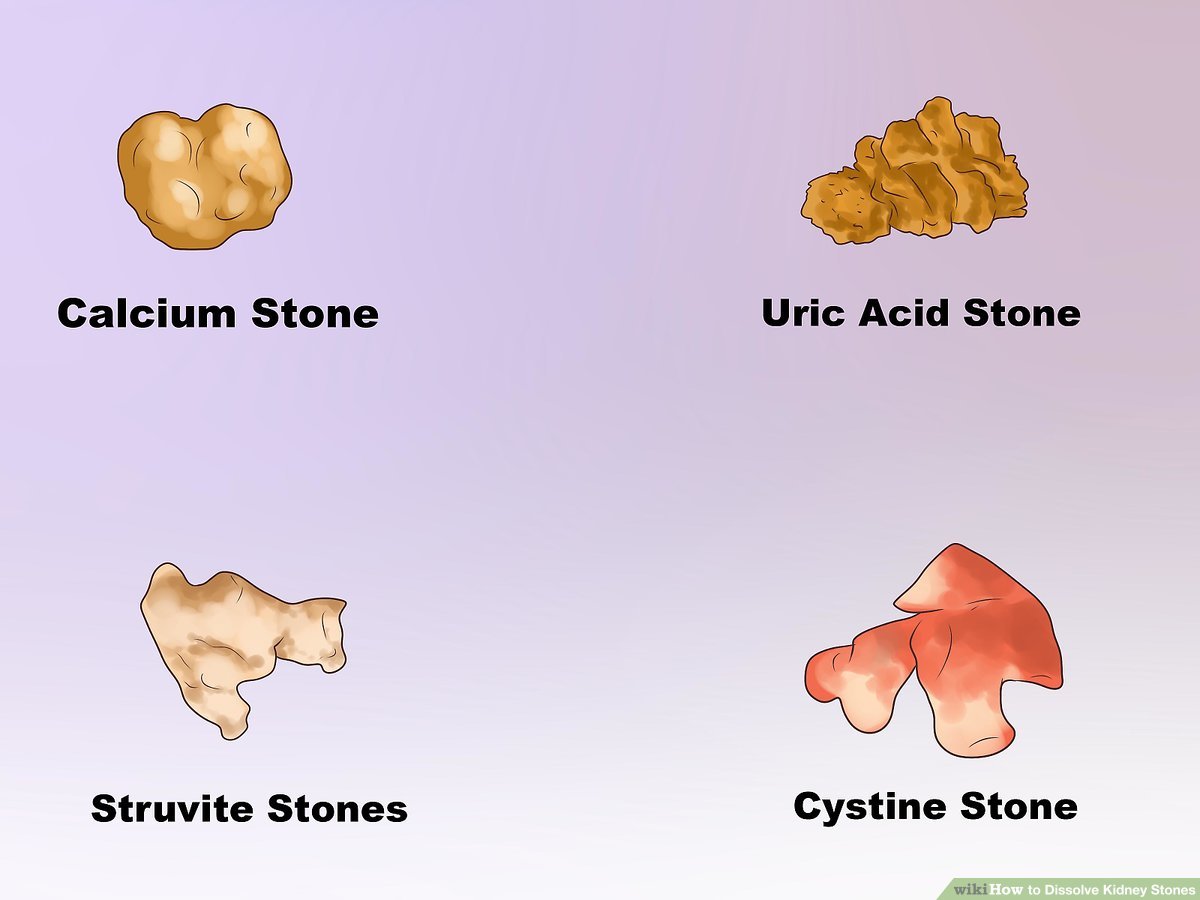 what-dissolves-a-kidney-stones-fast-doctor-tips